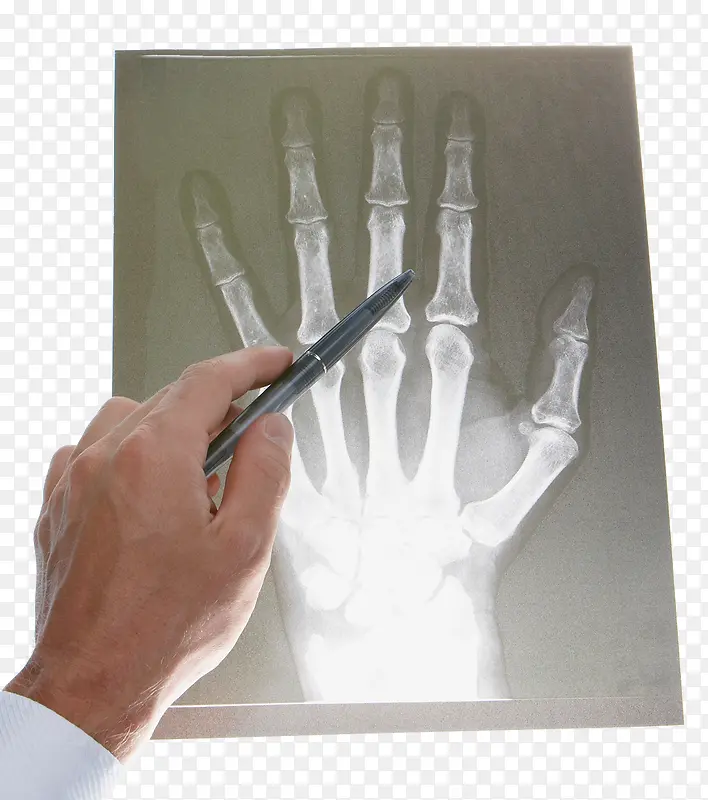 手指X光片