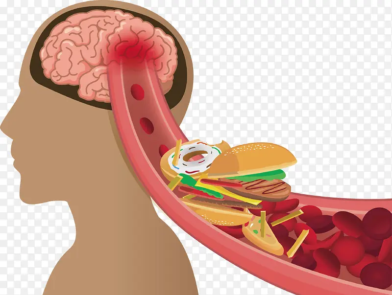 矢量大脑血管堵塞下载
