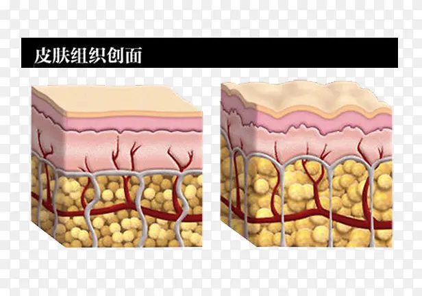 皮肤组织创面