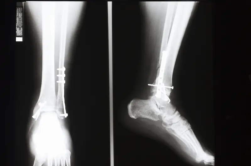被钉钉子修复中的脚踝骨透视片