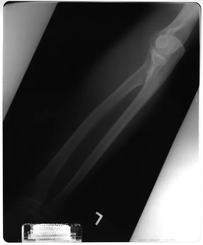 小手臂骨骼X光透视片