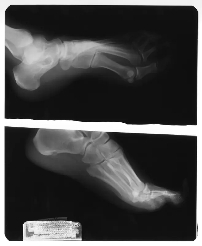 左脚骨骼X光透视片