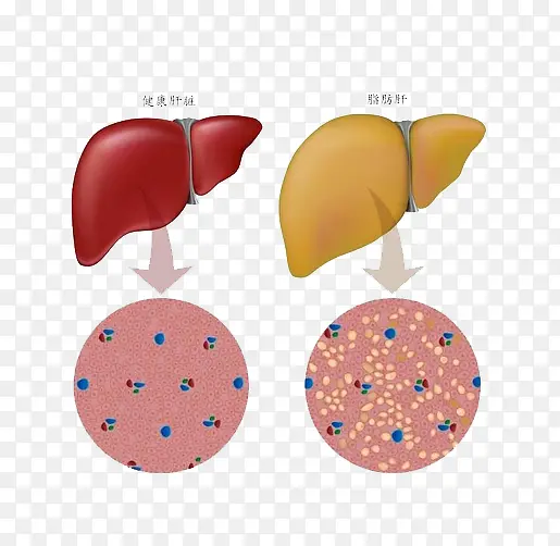 正常肝脏和脂肪肝对比图