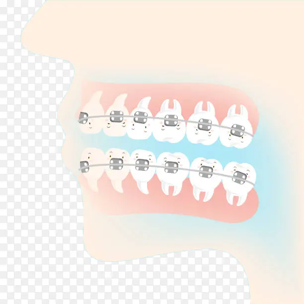 卡通矫正牙齿图示插画免抠