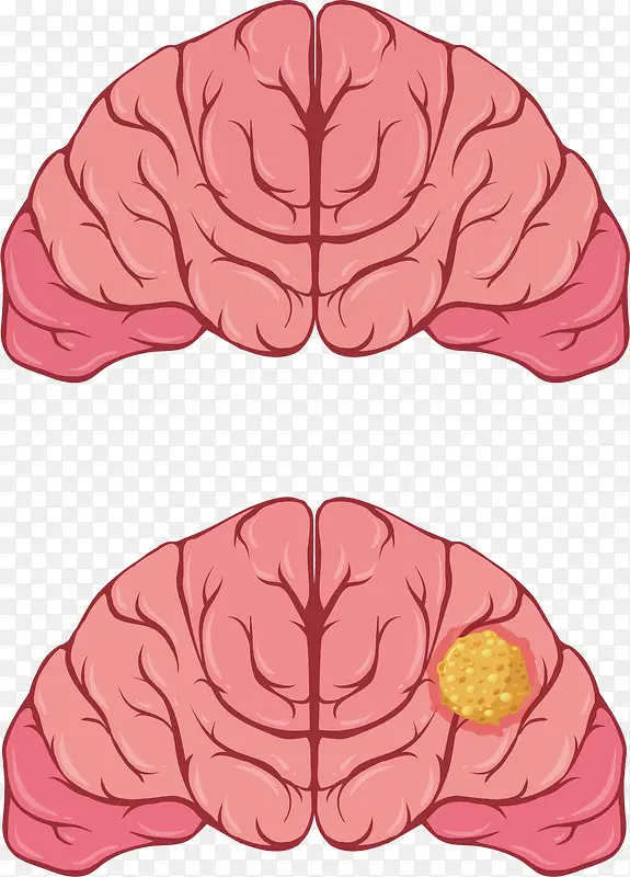 人类大脑疾病对比