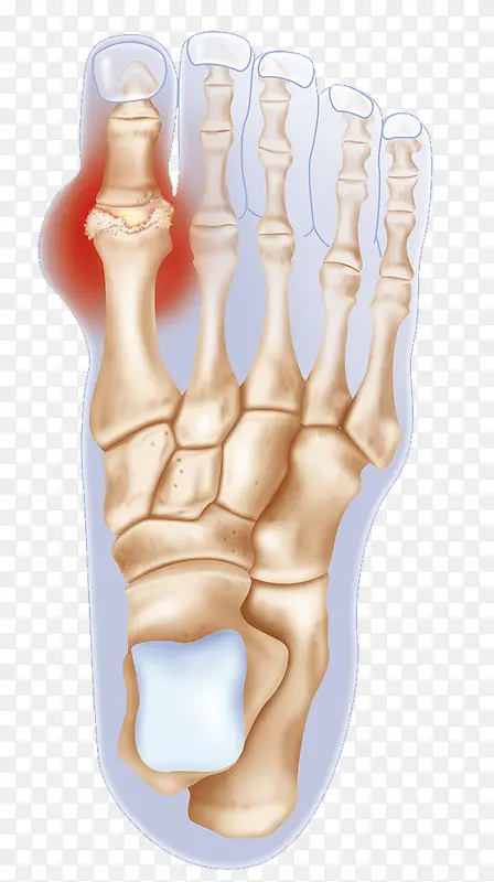 趾骨发炎炎症