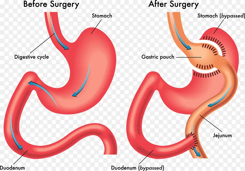 手术前后的肠胃变化