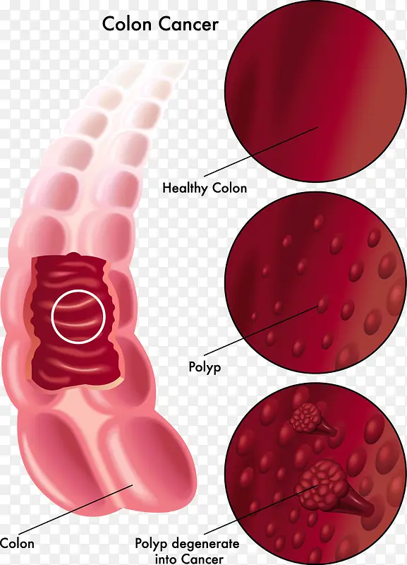 人体肠癌医学分析图