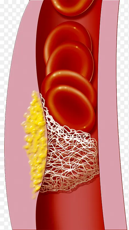血管脂肪
