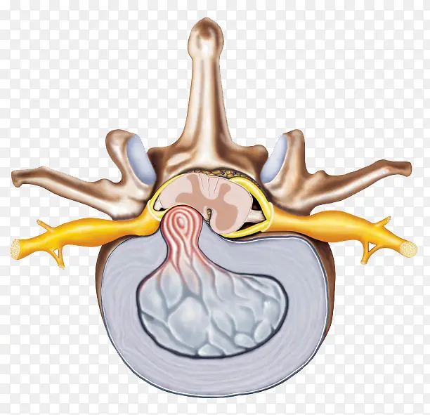 腰突腰椎间盘突出
